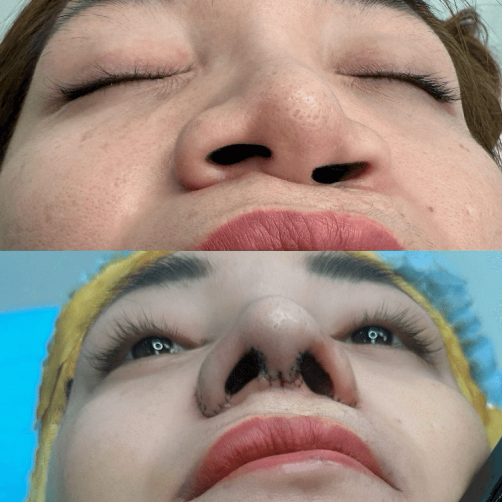 Rhinoplasty (Operasi Hidung)